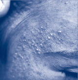 close up of chloracne on a person's face