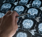 An X-ray of a person's brain An X-ray of a person's brain
