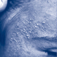 close-up of chloracne skin condition on a patients face.